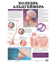 Плакат. Болезнь альцгеймера